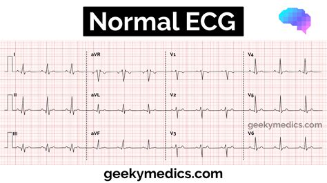 Normal Ecg Reading