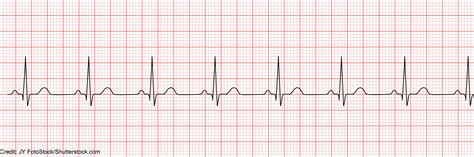 Normal Ekg Strip