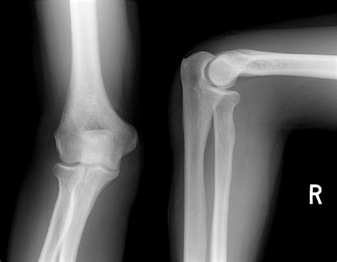 Normal Elbow Xray
