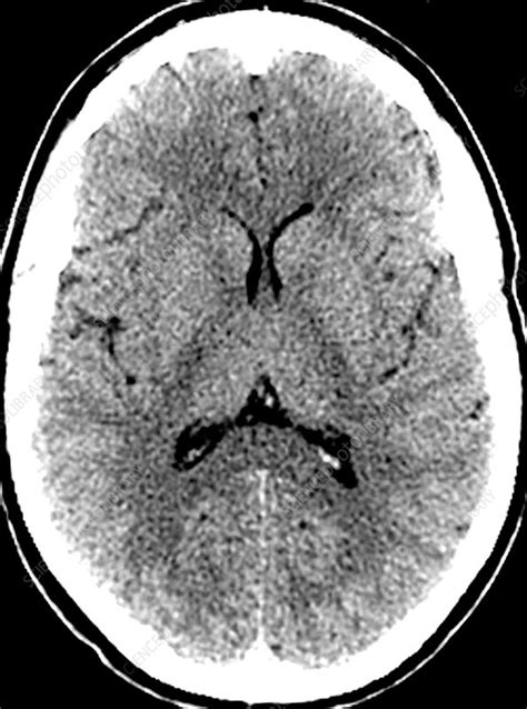 Normal Head Ct