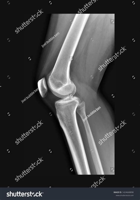 Normal Lateral Knee Xray