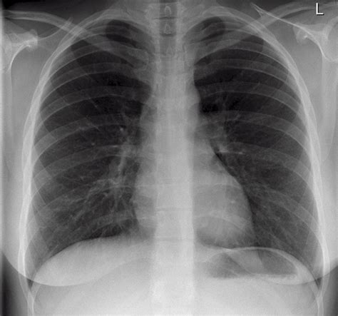 Normal Lung X Ray