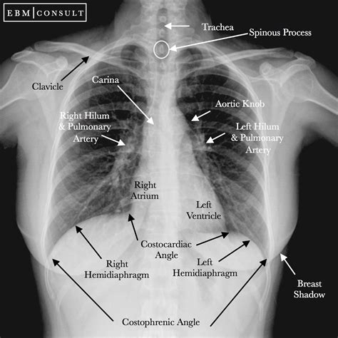 Normal Radiograph Of Chest
