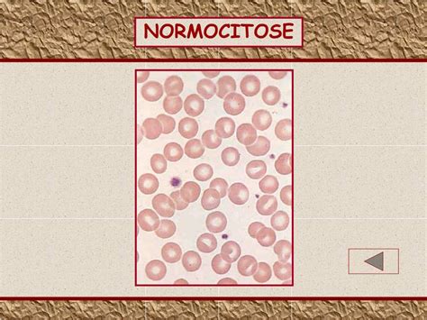 Normocitose E Normocromia