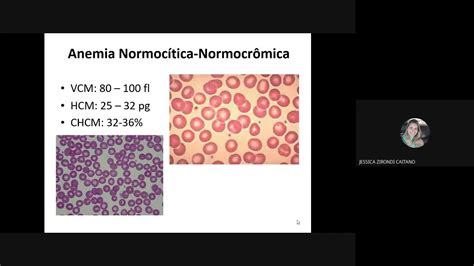 Normocromia E Normocitose