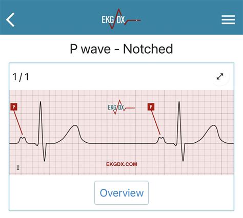 Notched P Wave