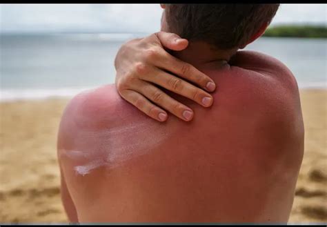 nude sunburn