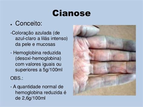 O Que é Cianose