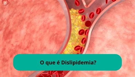 O Que é Dislipidemia
