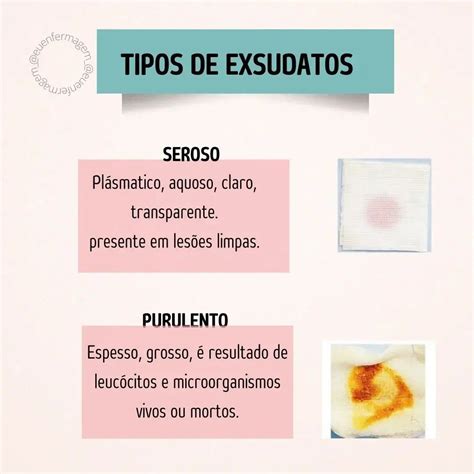 O Que é Exsudato