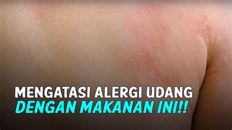 obat alergi udang