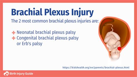 Read Obstetric Brachial Plexus Injuries 