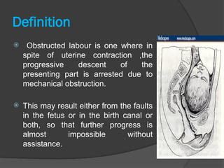 Obstructed Labour Definition