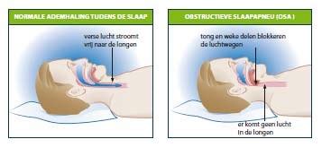 obstructieve apneu