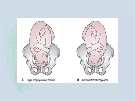 Occipito Posterior Position