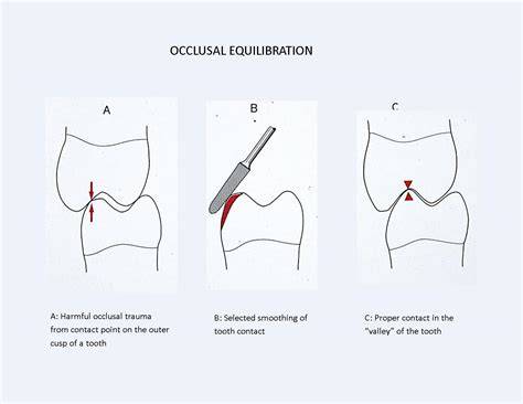 occlusal adjustment for treating and preventing