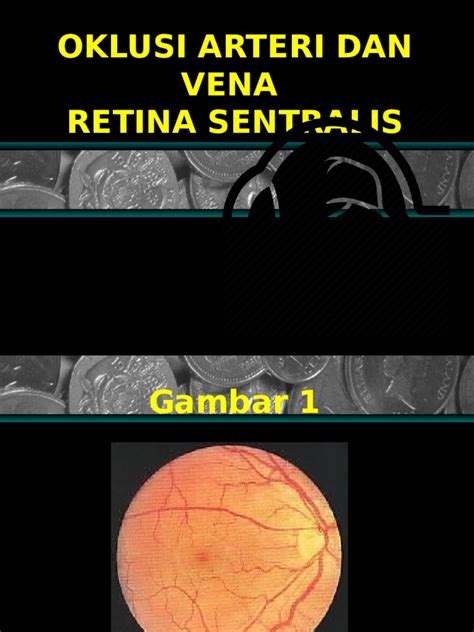 oklusi vena retina sentral pdf