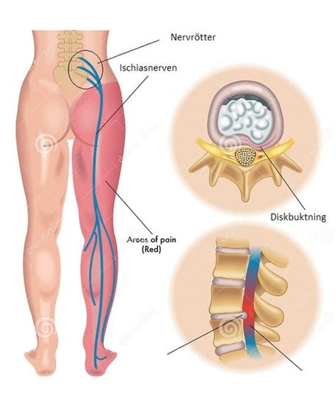 ont  inom rygg  då man springer