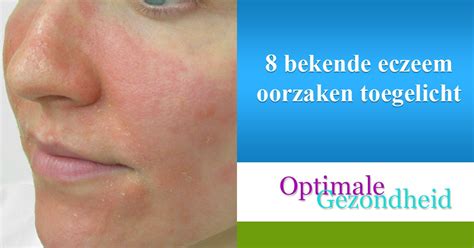 oorzaken eczeem