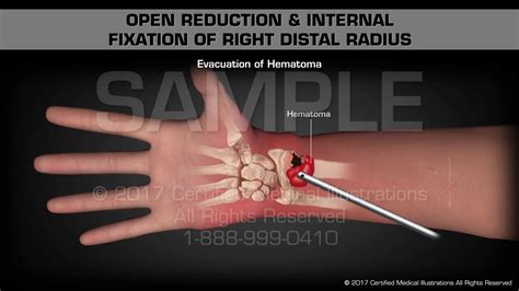 Open Reduction And Internal Fixation Orif