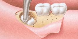 opererat visdomstand