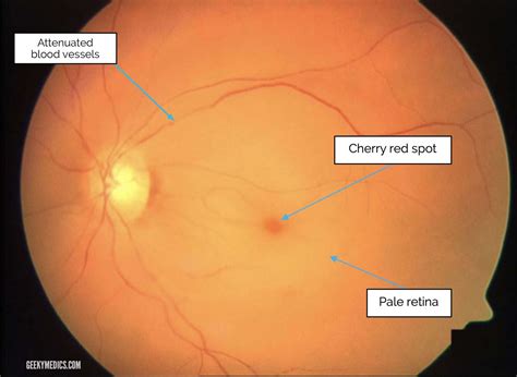 Ophthalmic Artery Occlusion