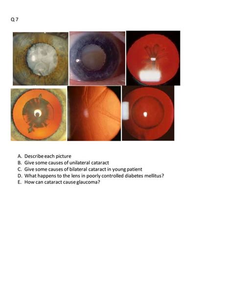 ophthalmology osce questions