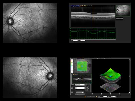 Optical Coherence Tomography