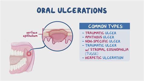 Oral Mucosal Ulcers