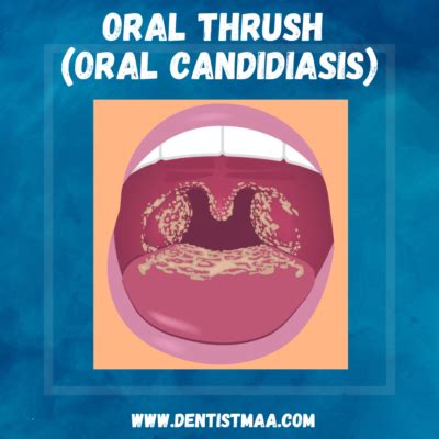 Oral Thrush Icd 10