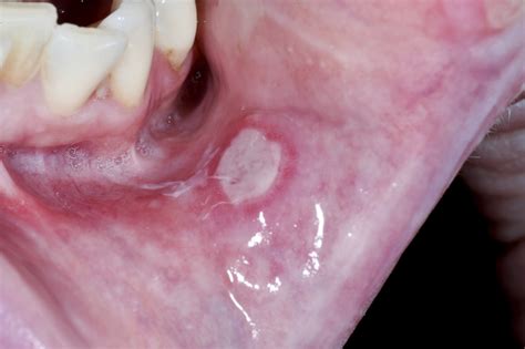 oral ulceration (mouth ulcer) in adults - General Practice notebook