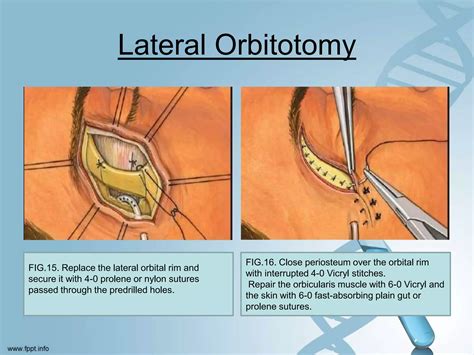 orbitotomy | orbitotomy Management of intraorbital metallic foreign body
