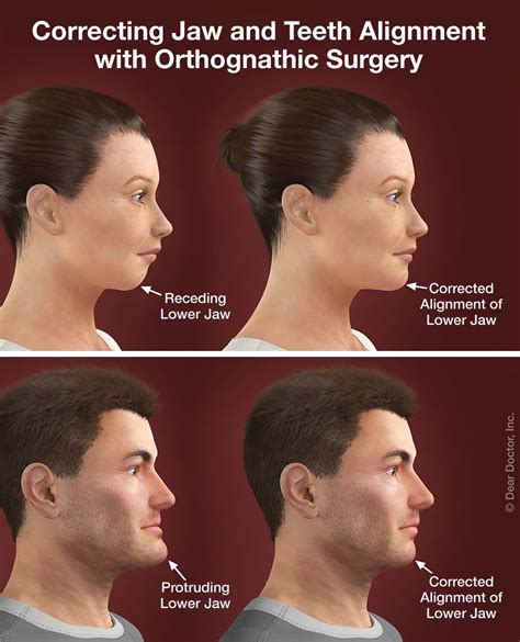Orthognathic Surgery