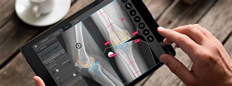 Orthopedic Software Walkthrough