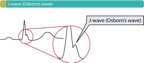 Osborn J Waves