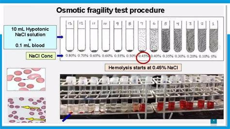 Osmotic Fragility Test