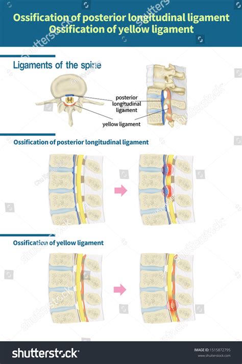 Ossification Posterior Longitudinal Ligament