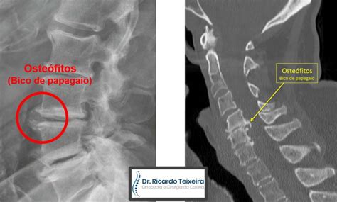 Osteofitose Marginal Incipiente