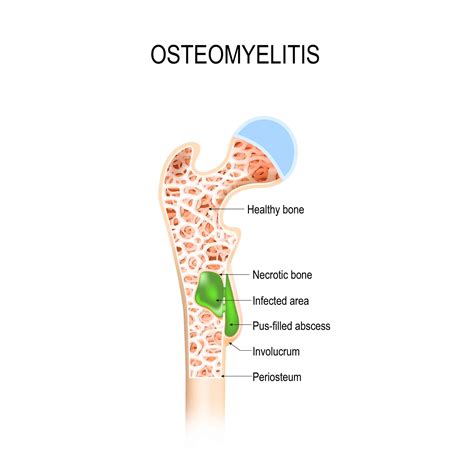 osteomielitis