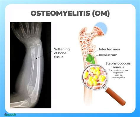 osteomyelitis 뜻