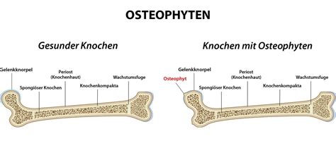 osteophytenbildung hüfte