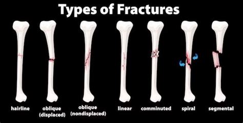 Osteoporosis Womenu0027s International Pharmacy Bone Fracture Worksheet - Bone Fracture Worksheet