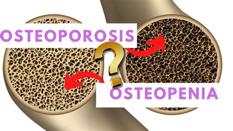 osteoporosis-4
