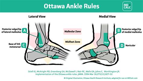 Ottawa Ankle Rules
