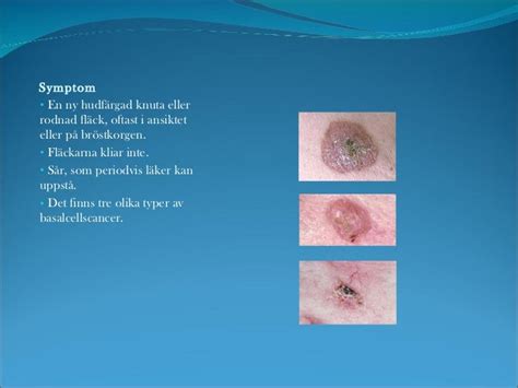 ovanlig hudcancer
