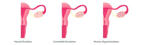 ovarian hyperstimulation syndrome ohss powerpoint