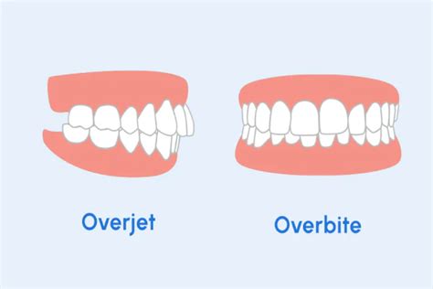 Overjet E Overbite