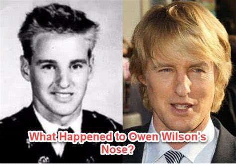 Owen Willson Nose