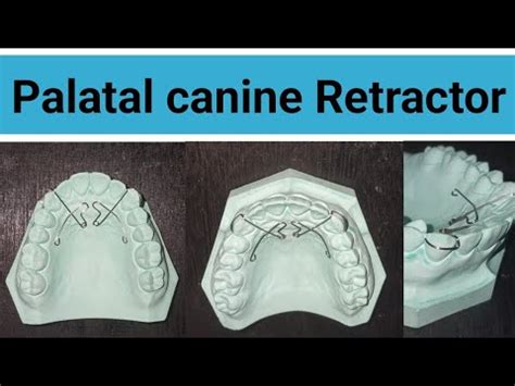 Palatal Canine Retractor