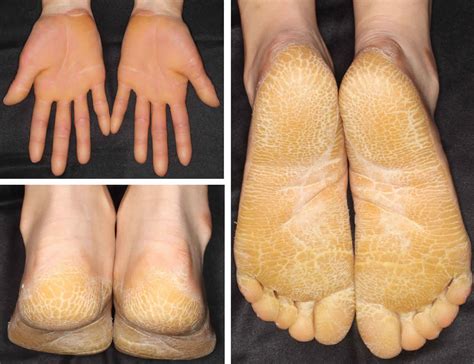Palmar Plantar Keratoderma